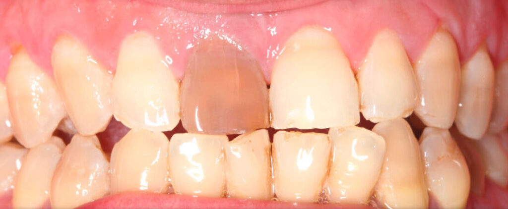 Internal Tooth Bleaching: Black Tooth Treatment | Aesthetic Dental Clinic