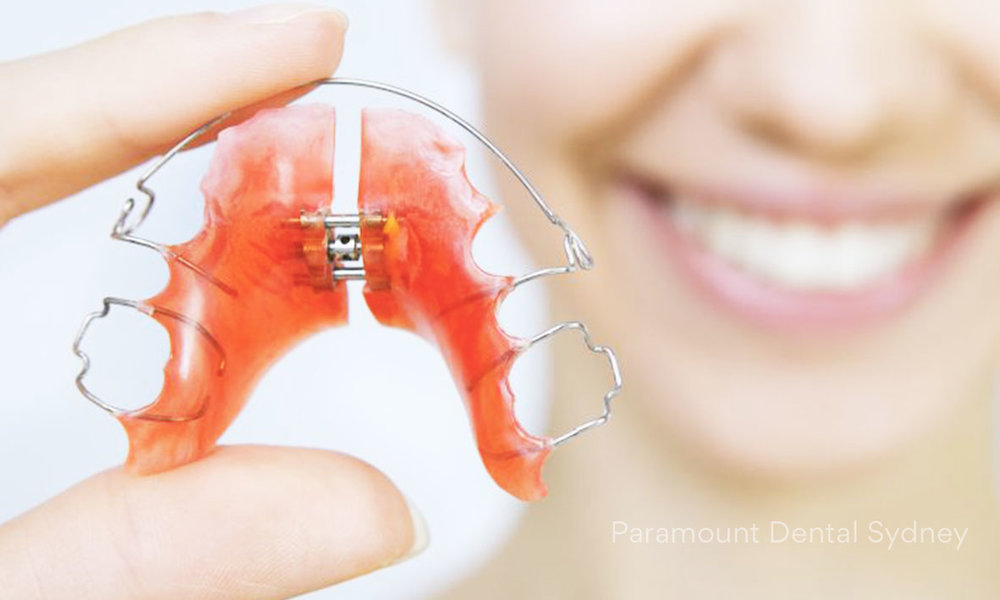 Instructions for braces-removable orthodontic appliances