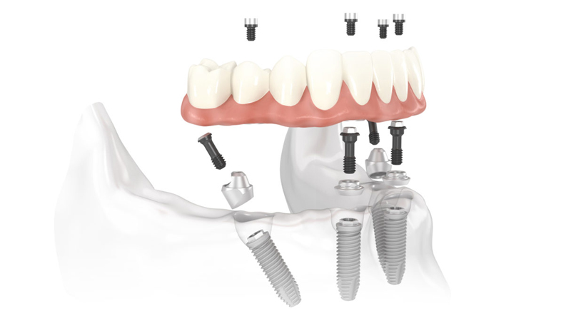 Dental Implants - All on 4, All on 6