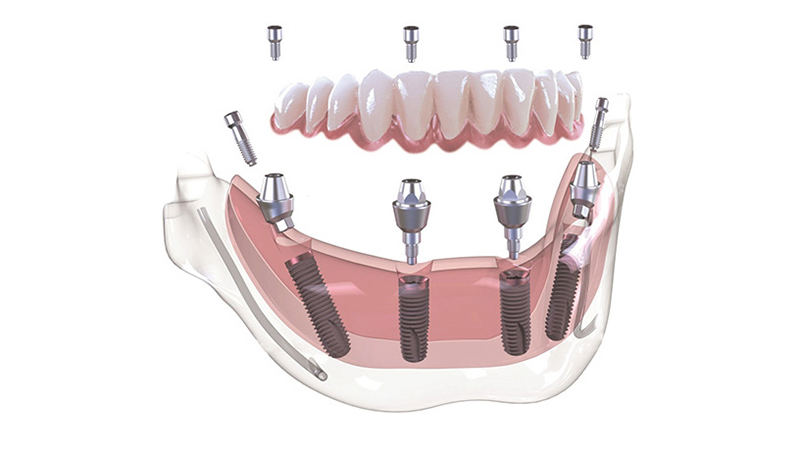 Dental Implants - All on 4, All on 6