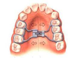 Rapid Maxillary Expansion